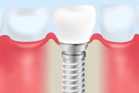 インプラント