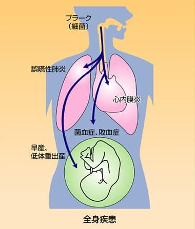 歯周病と全身疾患