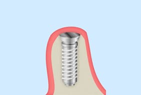 インプラント埋入