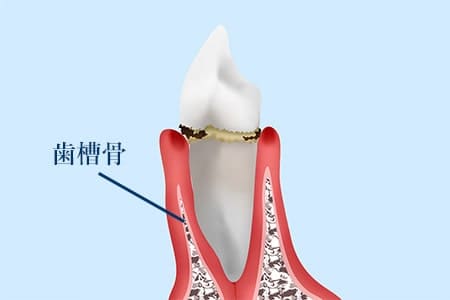 軽度歯周炎の場合