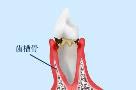 中等度歯周炎