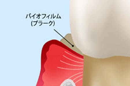 慢性歯周炎