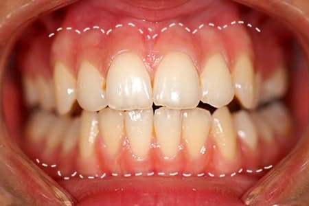角化歯肉幅の検査