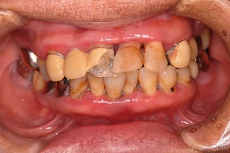 歯周病で歯を失ってしまうメカニズム