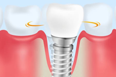 インプラント周囲炎を放置するリスク