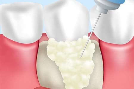 エムドゲインを使った歯周組織再生療法