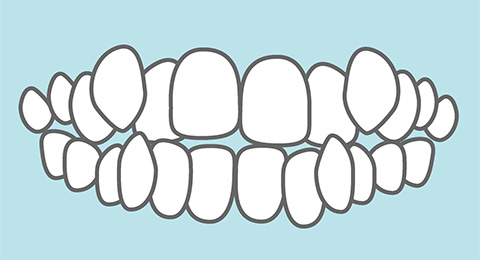 デコボコの歯（叢生）