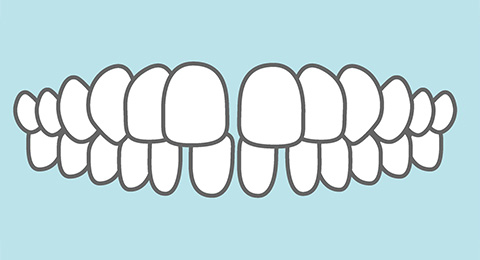 すきっ歯（空隙歯列）