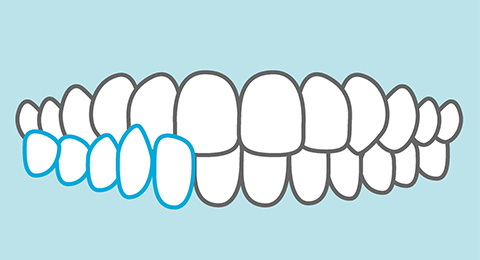 交叉咬合(こうさこうごう)