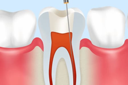 抜髄根管治療