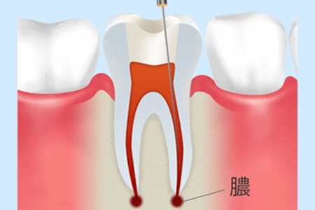 感染根管治療