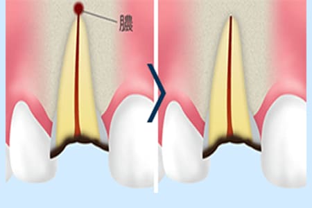外科的根管治療（歯根端切除）