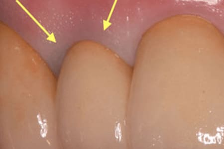 重度の虫歯には根管治療を