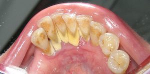 Mandibular-Anterior-Calculus