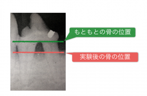 Occlusion-related-to-Periodontitis