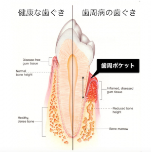 pocket-depth