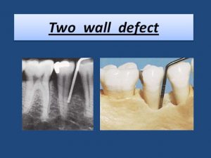 bone-loss