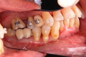 orthodontic-treatment-2