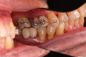 orthodontic-treatment-3