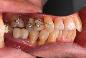 orthodontic-treatment-4