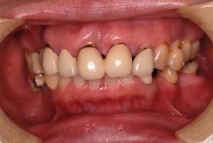 periodontal-initial-treatment-1