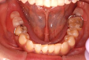 Partial-Denture-Occlusal-View