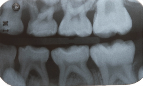periodontitis-in-children