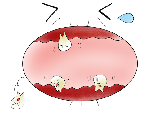 歯が自然に抜けることもある『重度歯周炎』とは？？