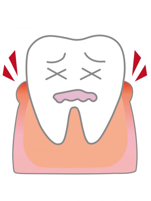 歯周病検査④ BOP