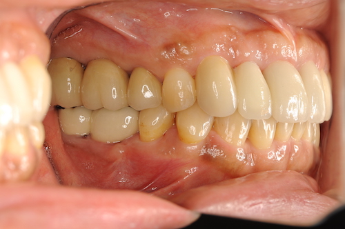 歯周病治療でのインプラントのメリット