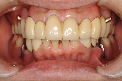 歯周病治療の最終段階『歯周補綴』