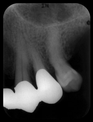 歯周病検査② レントゲン検査