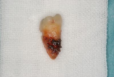歯周病の最大の原因『歯肉縁下歯石』とは？？