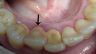 歯周病の初期段階「縁上歯石」を放置することで起きること