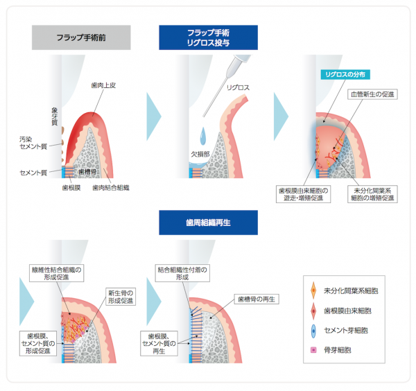 リグロスを使った歯周病治療を行なっています。