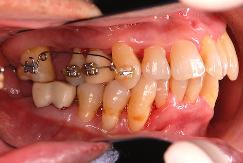 歯周矯正治療の方法と期間