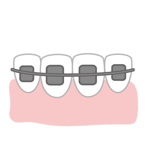 歯周病治療のための「矯正治療」３つのメリットとは？