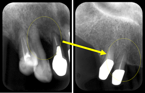 歯周病の理想的な治療「再生療法」とは？