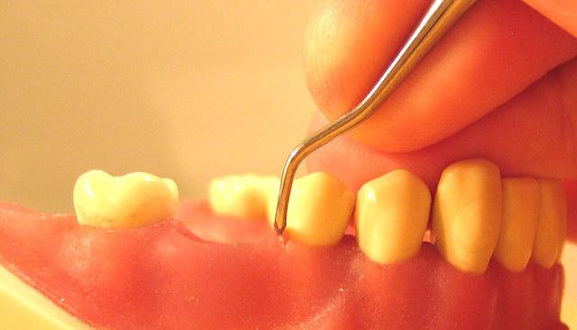 縁下歯石を除去する治療「SRP」と使用している道具