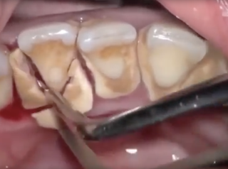 歯周初期治療「縁上歯石の除去」の動画
