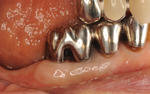 歯周病になりにくい歯ぐきを作る治療『遊離歯肉移植術』とは？
