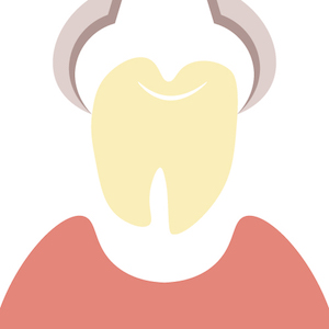 歯周病の抜歯以外の治療方法はありますか？