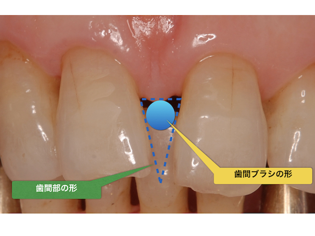 歯間ブラシを使う上で注意しなければならないこと