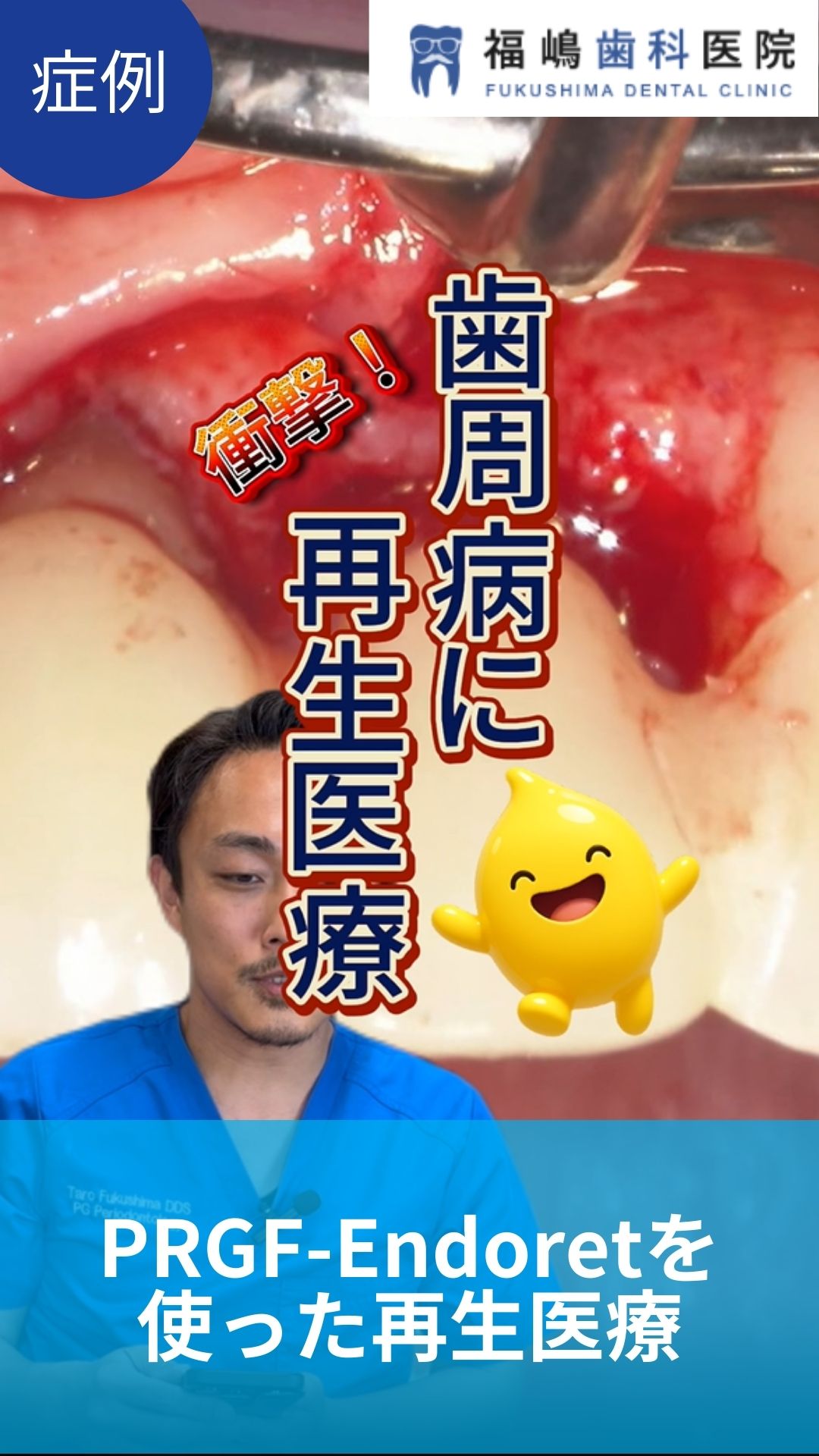 PRGF-Endoretを 使った再生医療