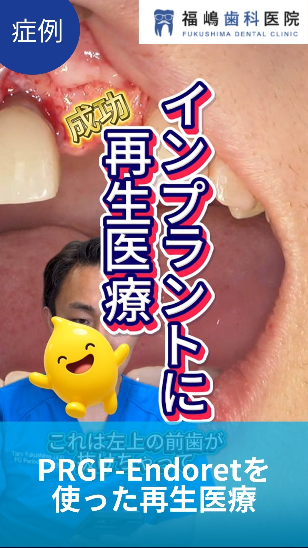 PRGF-Endoretを 使った再生医療