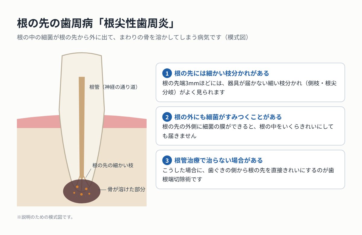 根尖性歯周炎の模式図