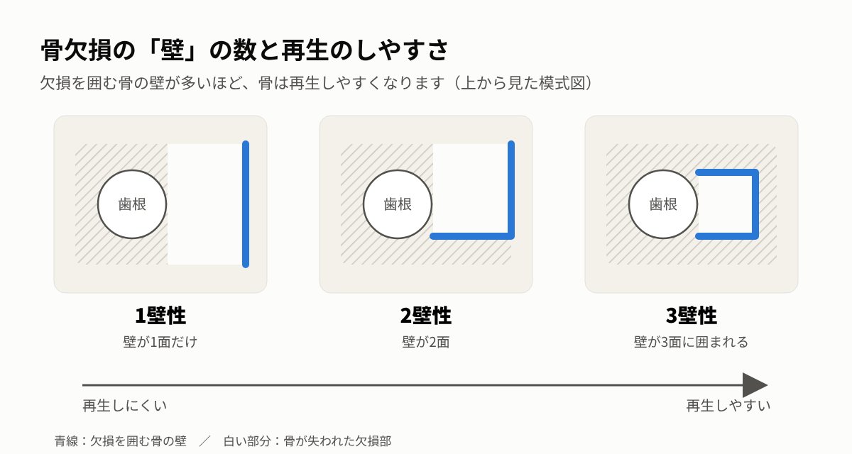骨欠損の壁の数（1壁性・2壁性・3壁性）と再生のしやすさの模式図