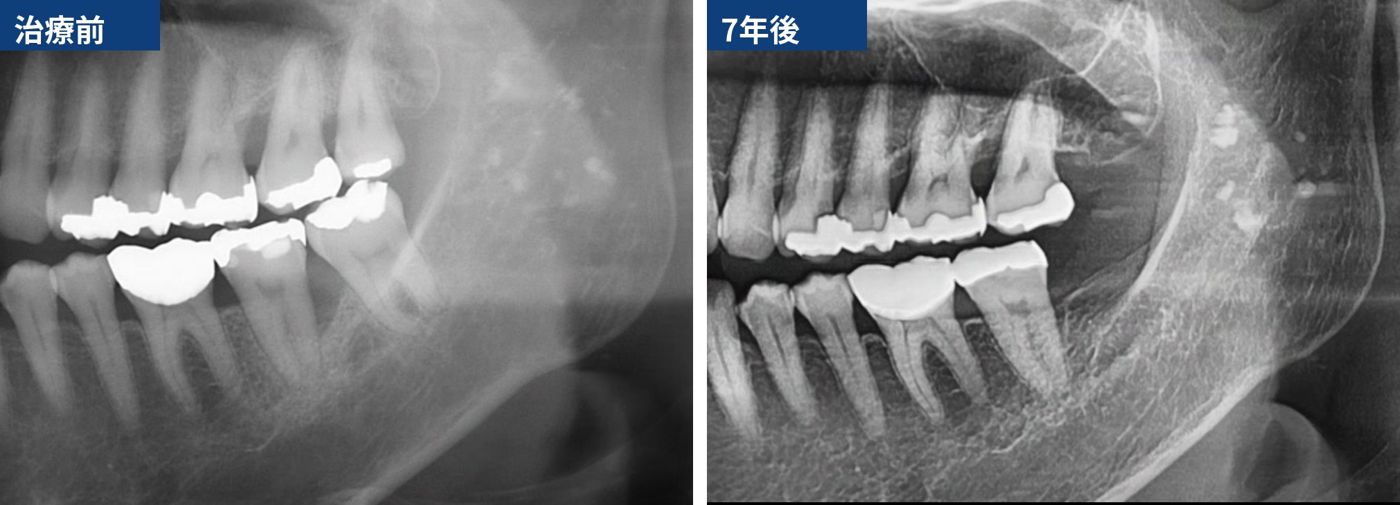 【症例】エムドゲインによる奥歯の歯周組織再生療法|6mmの垂直性骨欠損 治療前と7年後