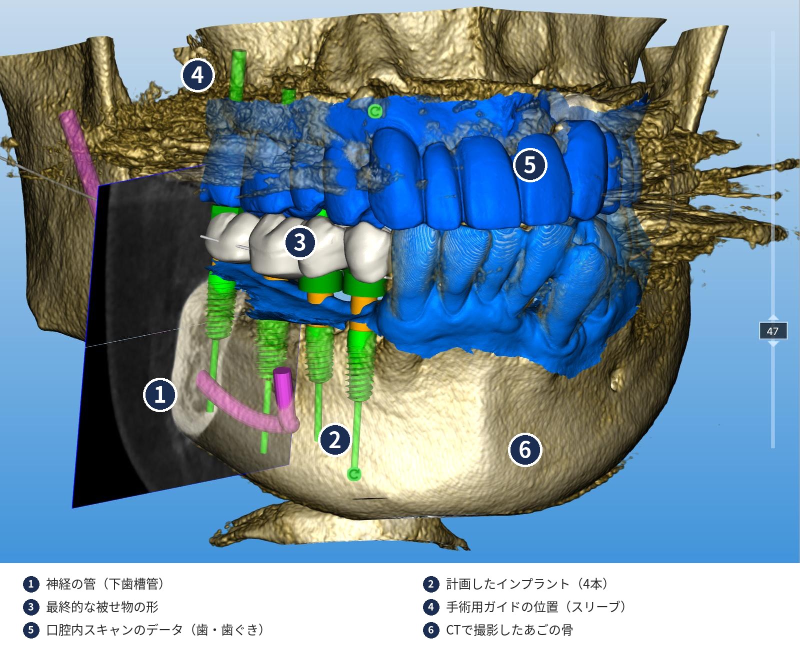 インプラント計画の3D画像に番号をつけた解説図。神経の管、計画したインプラント4本、被せ物の形、手術用ガイドの位置、口腔内スキャンのデータ、あごの骨