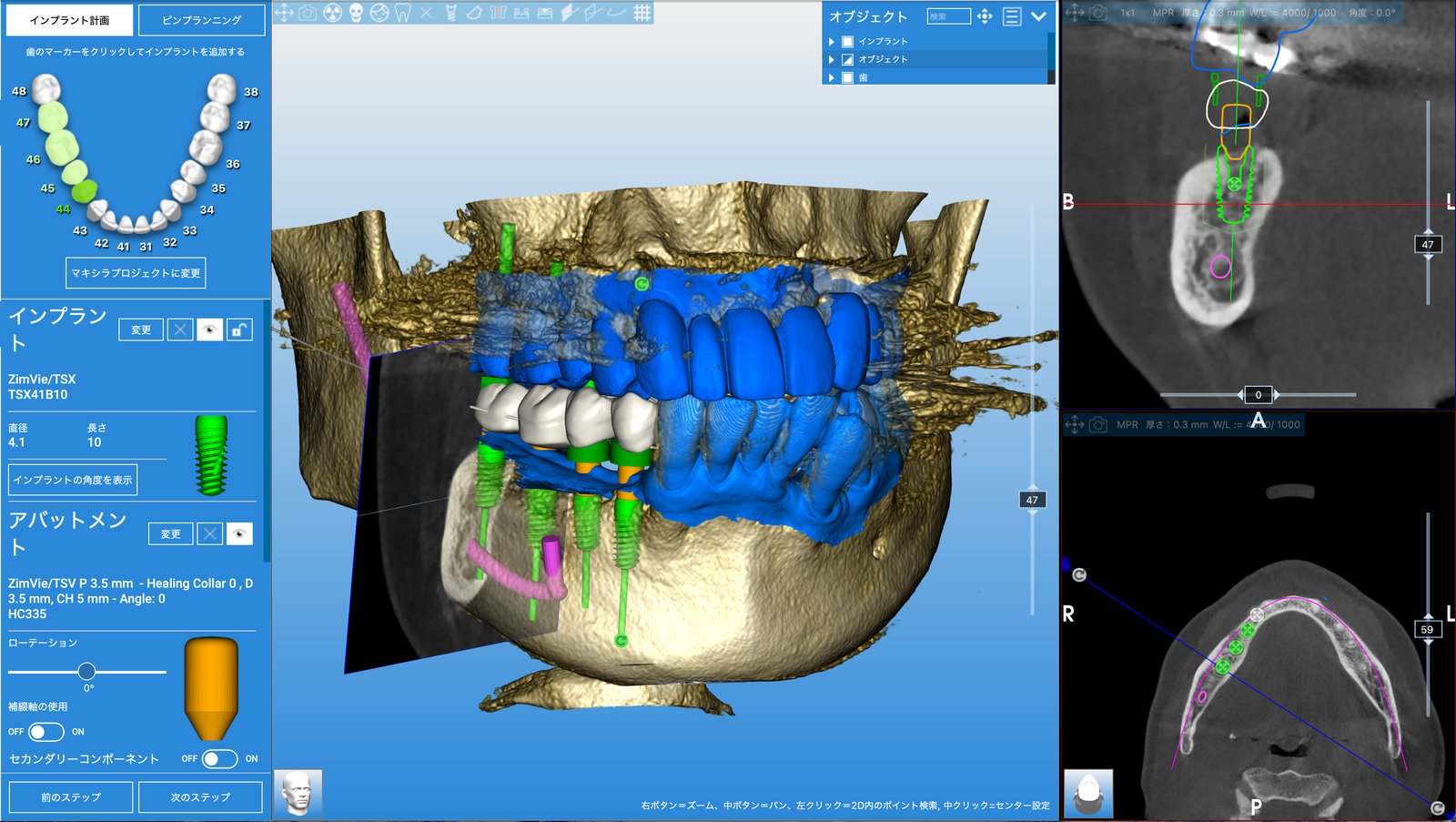 インプラント計画ソフトの画面全体。3Dのあごの骨、計画したインプラント、CTの断面画像が表示されている